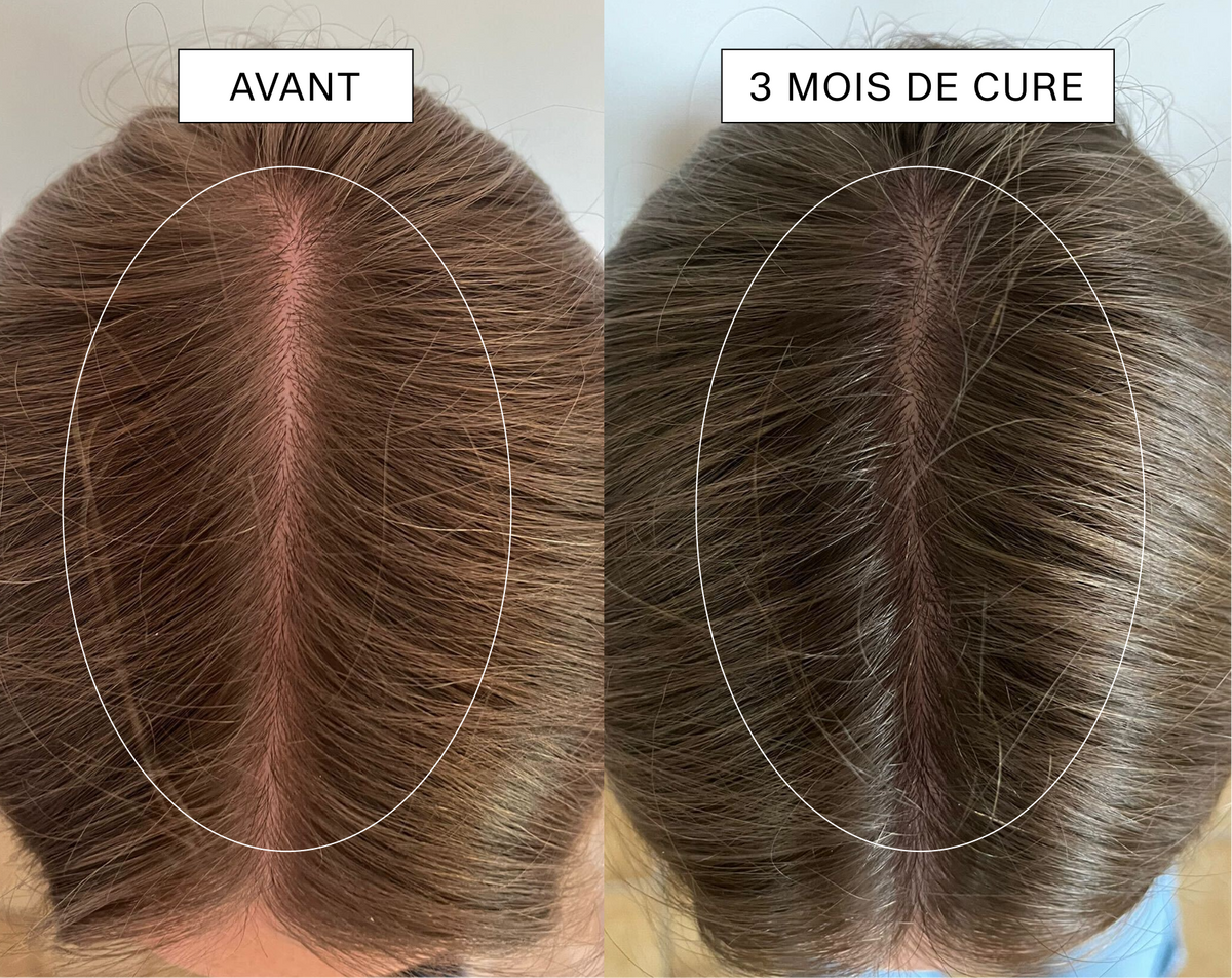 Comparaison avant et après une cure de 3 mois pour la densité et la pousse des cheveux.