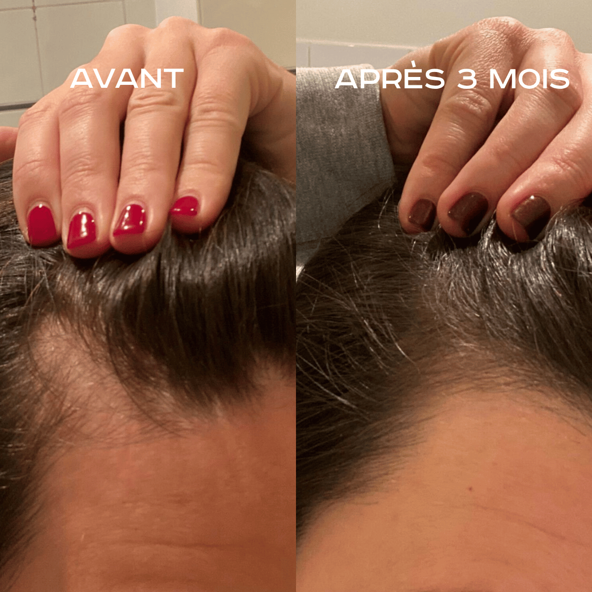 Avant et après trois mois : comparaison du cuir chevelu publiée par Hygée